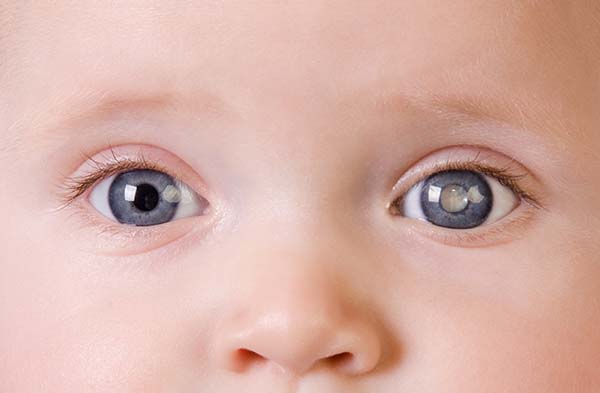Diagnosis Investigation and Treatment of Congenital Cataract