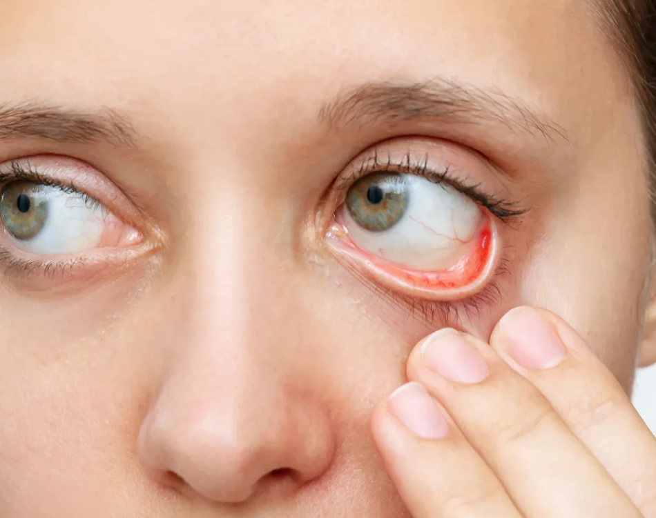 Clinical Approach to Conjunctivitis